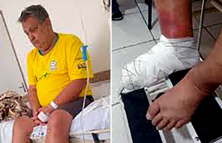 Pedreiro pisa em brinco, tem infecção e precisa amputar o pé após aguardar por vaga em hospital