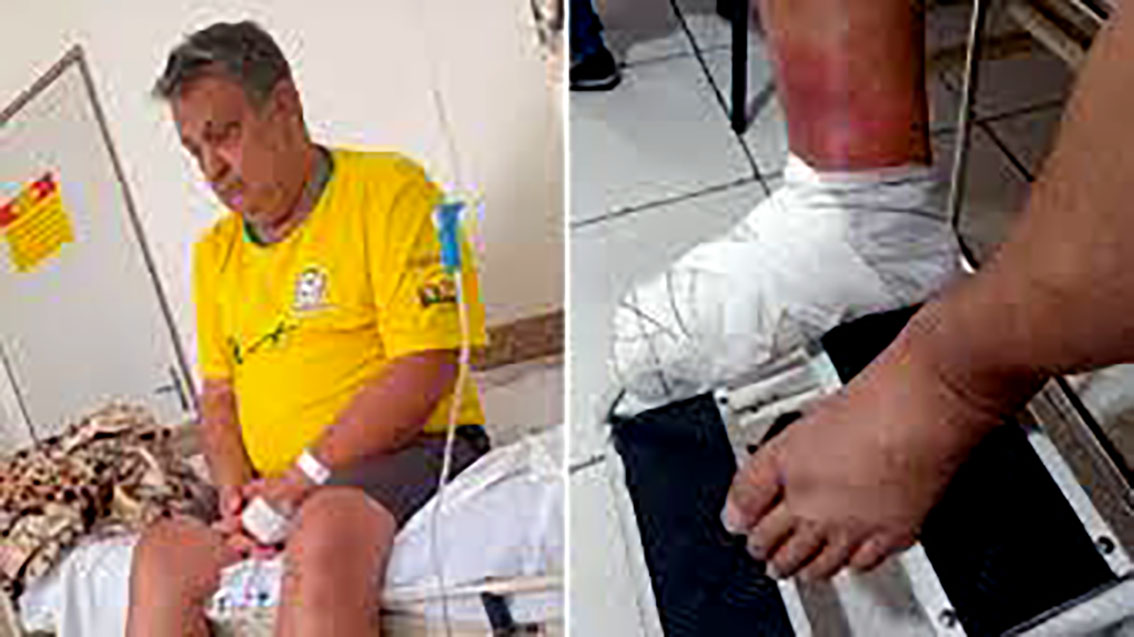 Pedreiro pisa em brinco, tem infecção e precisa amputar o pé após aguardar por vaga em hospital